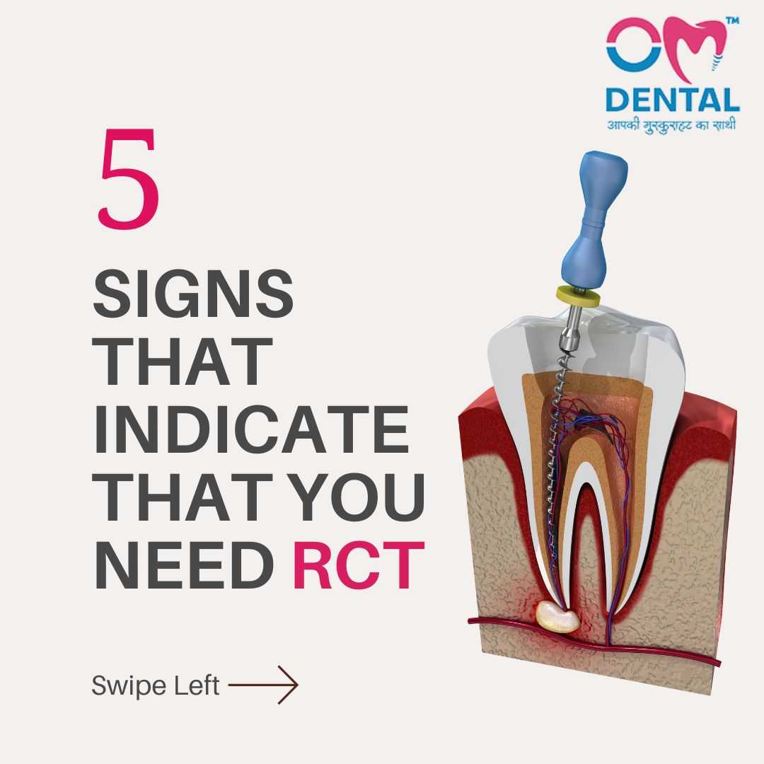 5 Signs That Indicate You Need Root Canal Treatment (RCT) - Om Dental Nagpur Clinic