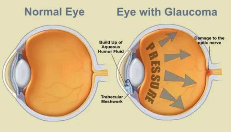 A Clearer Vision: Exploring Glaucoma Treatment In Chinchwad