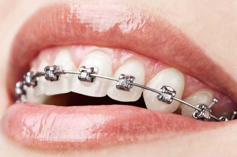 A Good Dentist For Braces Treatment In Pitampura