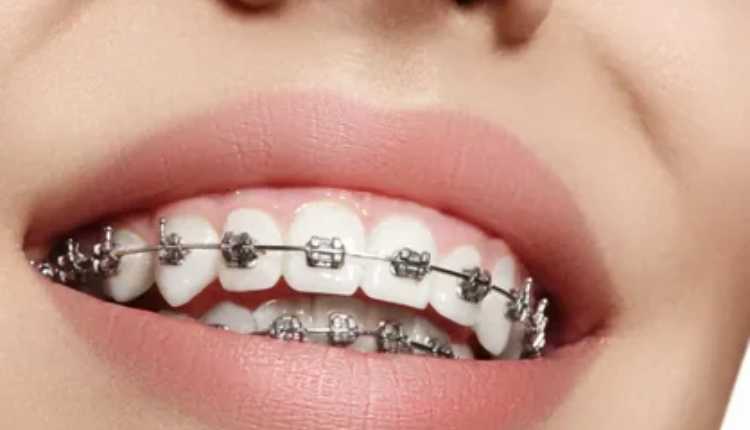 Advancements In Digital Impressions For Braces