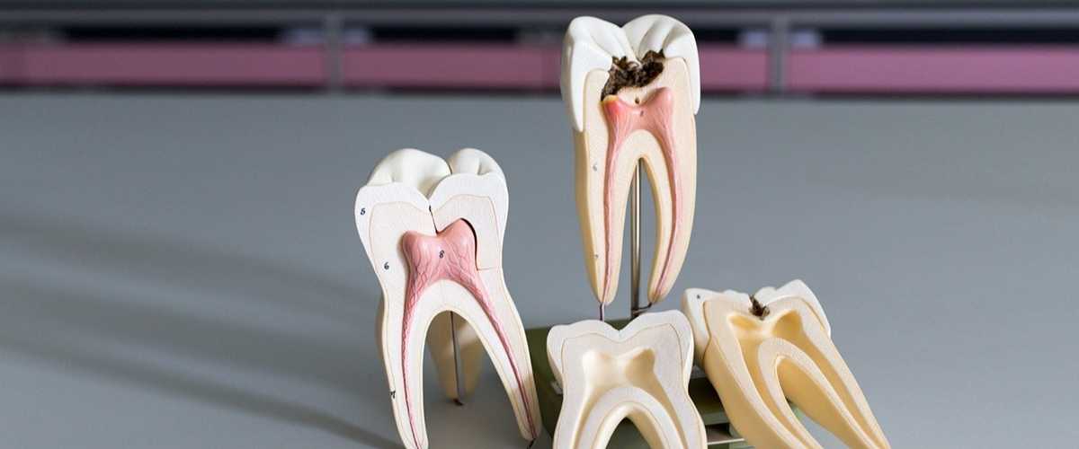 Affordable Root Canal Treatment In Kodungallur