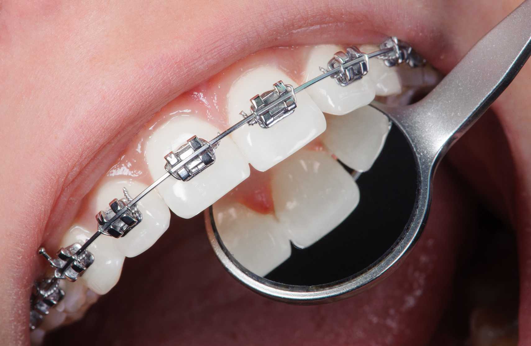 Benefits Of Advanced Technology In Self-Ligating Braces
