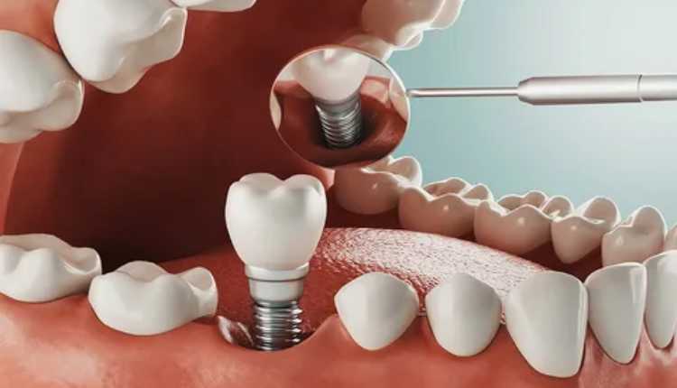 Decoding Dental Implants Cost In Badlapur: A Comprehensive Guide