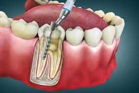 Dispelling Myths About Root Canal Treatment: Separating Fact From Fiction