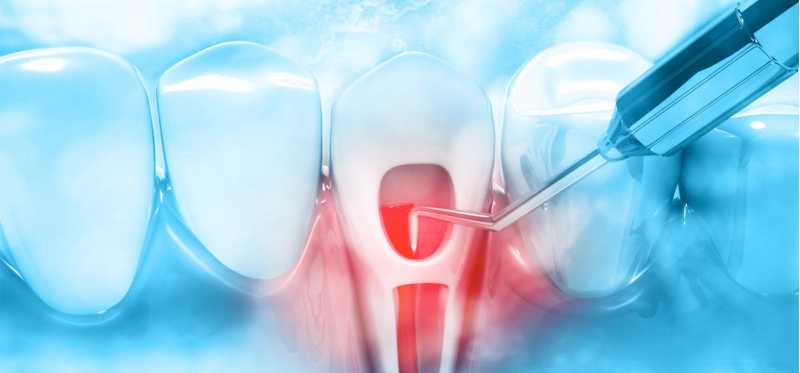 Enhance Your Smile: Root Canal Treatment In Bilaspur