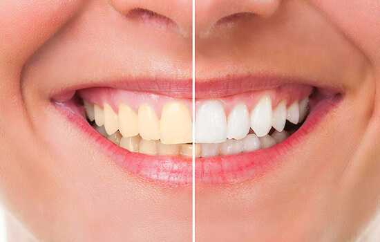 Everything You Should Know About Dental Fillings