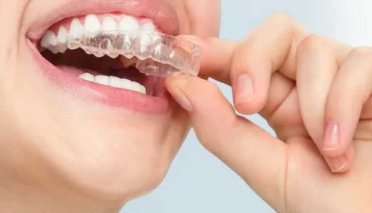 Exploring The Benefits Of Invisalign Aligners In Chembur: A Comprehensive Guide