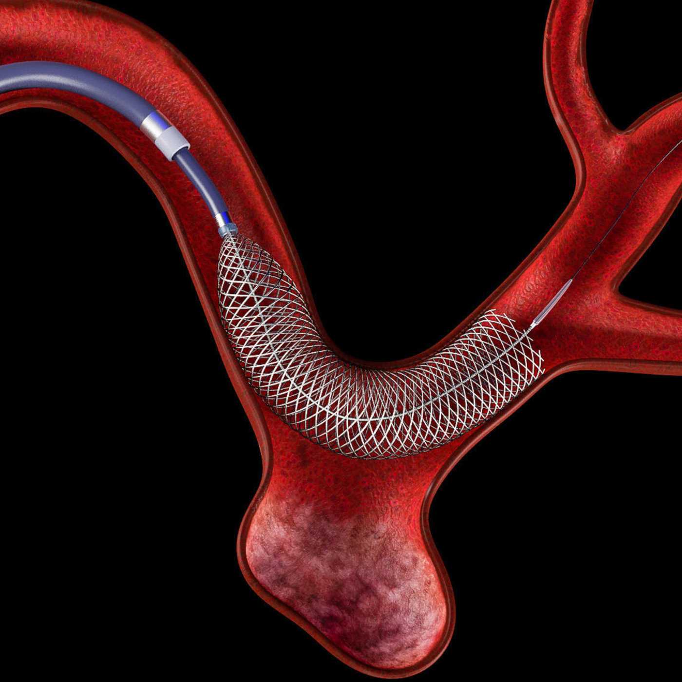 Flow Diverters Market: Advancements In Neurovascular Treatment