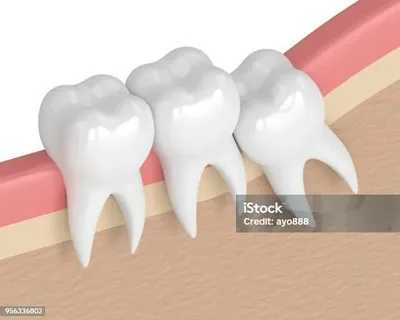 Heal Faster  And Avoid Complications In Wisdom Tooth Removal