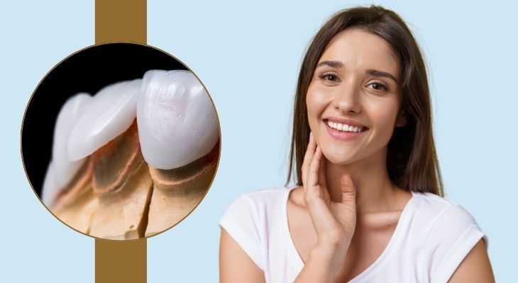 Porcelain Veneers In Delhi – Achieve The Smile Of Your Dreams