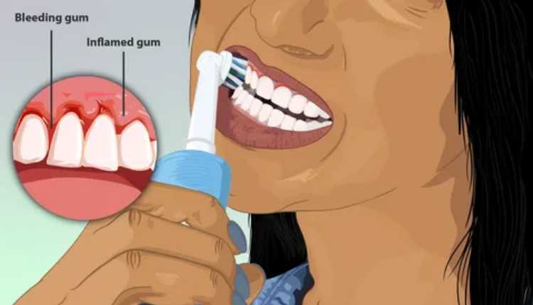 Putting An End To Discomfort: Bleeding Gum Treatment In Badlapur