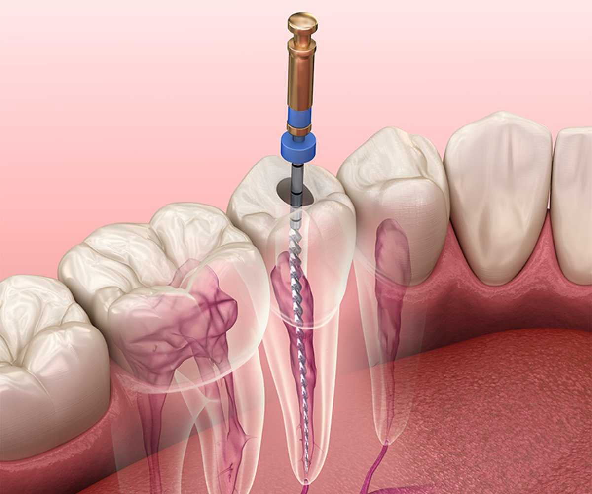 Root Canal Recovery: Tips For A Smooth Healing Process