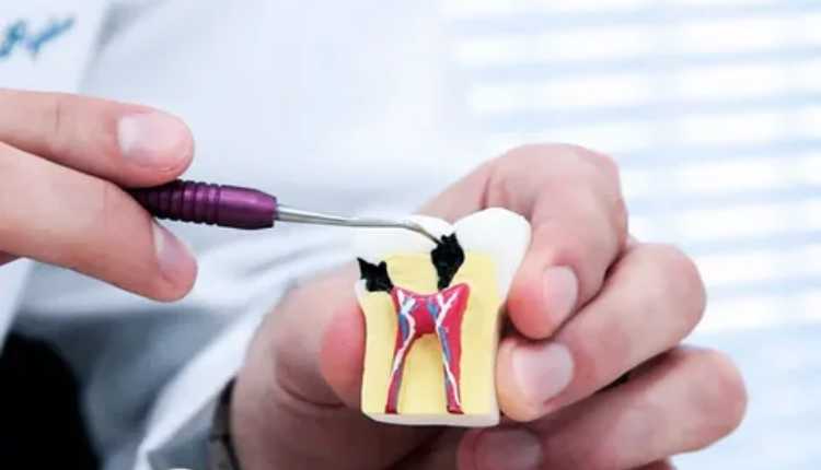 Root Canal Treatment In Kandivali: Nurturing Healthy Smiles