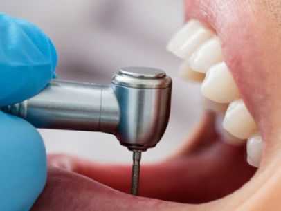 Root Canal Treatment In Nallagandla: A Comprehensive Guide To Dental Health
