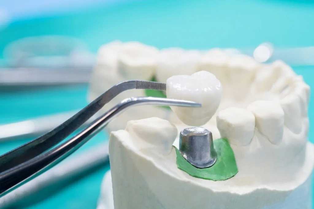 Smart Spending For A Healthy Smile: A Guide To Dental Crown Costs In Baner
