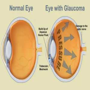 A Clearer Vision: Exploring Glaucoma Treatment In Chinchwad
