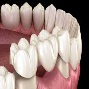 A Complete Guide To Dental Bridges - Everything You Need To Know