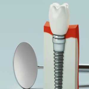 A Comprehensive Guide To Dental Implant Treatment In Noida