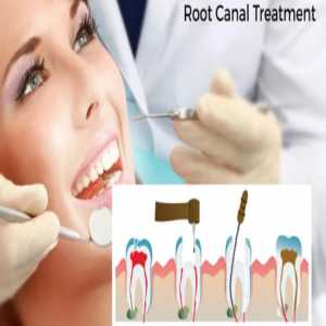 A Comprehensive Guide To Root Canal Treatment In Nizamabad