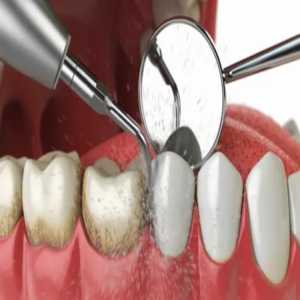 A Comprehensive Guide To Teeth Cleaning In Pondicherry