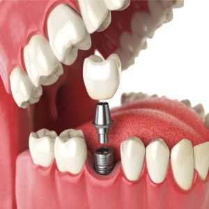 A Smile That Lasts A Lifetime: Explore Dental Implants As A Long-Term Solution In Nagpur