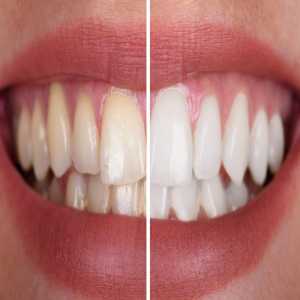 Achieve Brilliantly White Teeth With Professional Teeth Whitening