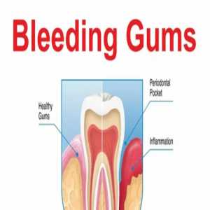 Addressing Bleeding Gum Treatment In Pondicherry: A Comprehensive Guide