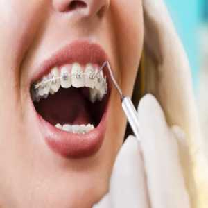 Braces And Social Life: Maintaining Confidence And Comfort