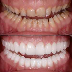 Can Full Mouth Restoration Fix Missing, Broken, And Worn Teeth?