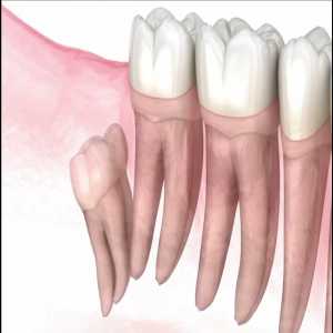 Can Wisdom Teeth Cause Dental Misalignment?