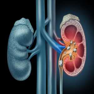 Can You Treat Kidney Stones Without Surgery?