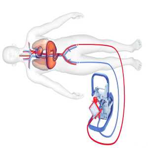 Cardiopulmonary Oxygenator Market: A Vital Component In Modern Cardiac Care