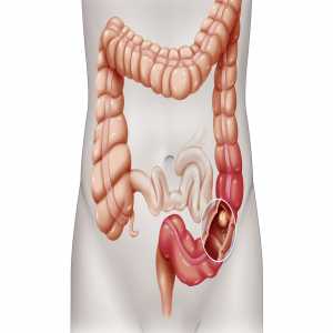 Colorectal Cancer Treatment Market Size, Status, Analysis And Forecast 2030