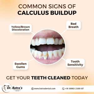 Common Signs Of Calculus Buildup - Keeping Your Smile Healthy At Batra Dental Clinic