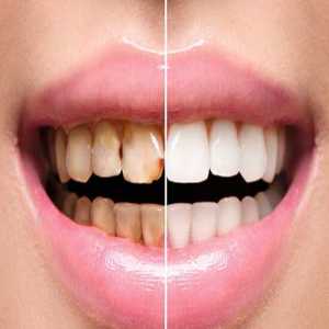 Complete Transformation Full Mouth Dental Rehabilitation In Mulund East, Mumbai