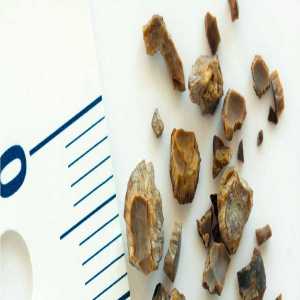 Comprehensive Guide On Treating Kidney Stones In Senior Citizens