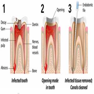 Demystifying Root Canal Treatment Cost In Nagpur - Quality Care At Affordable Prices