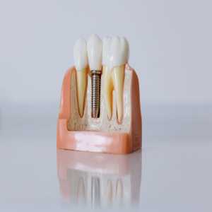 Dental Implant Treatment In Bilaspur At Rai Dental Clinic