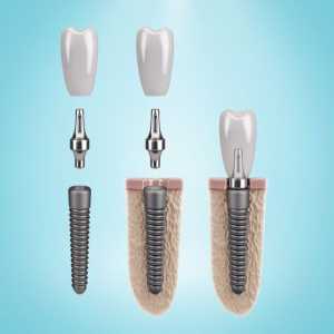 Dental Implants And Multi-Specialty Practices: Coordinated Patient Care