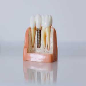 Dental Implants And Treatment Outcome Predictions: Prognostic Factors