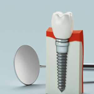 Discover The Benefits Of Dental Implant Treatment in Gangapur Road, Nashik