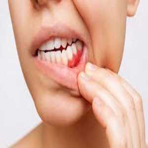 Don't Ignore Bleeding Gums! Here's What You Can Do