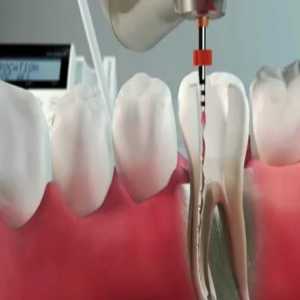 Embracing The Efficiency Of Single Sitting Root Canal Treatment In Vijayawada