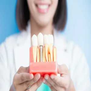 Everything You Need To Know About Dental Implants In Kandivali East