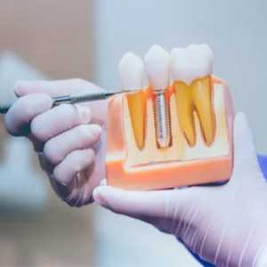 Everything You Need To Know About Dental Implants In Madhapur