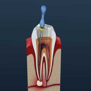 Everything You Need To Know About Root Canal Treatment In Pune Camp