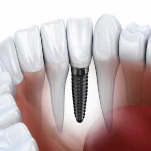 Finding The Right Dentist For All On 4 Dental Implants In San Diego