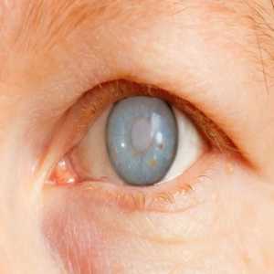 Glaucoma Awareness: Detecting And Managing The Silent Thief Of Sight