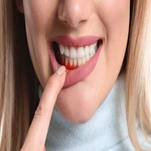 Gum Treatment At Veda Dentistry, East Delhi - Rediscover Your Smile