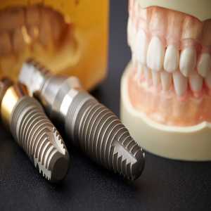 How Dental Implants Can Transform Your Oral Health